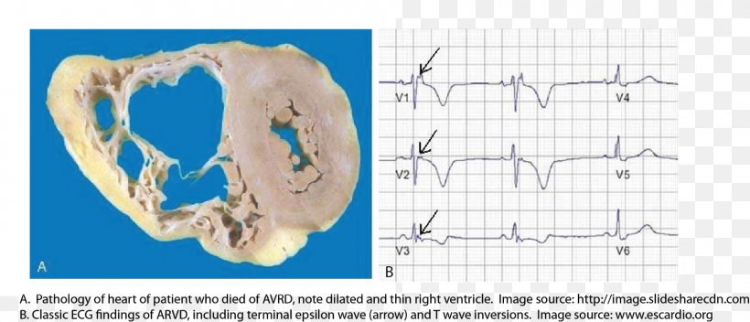 Arrhythmogenic Right Ventricular Dysplasia Hypertrophic Cardiomyopathy Dilated Cardiomyopathy Naxos Syndrome, PNG, 1600x688px, Watercolor, Cartoon, Flower, Frame, Heart Download Free