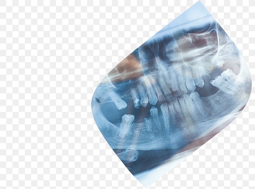 Dentistry Tooth Dental Implant Orthodontics, PNG, 800x608px, Dentistry, Blue, Crystal, Dental Implant, Dental Radiography Download Free