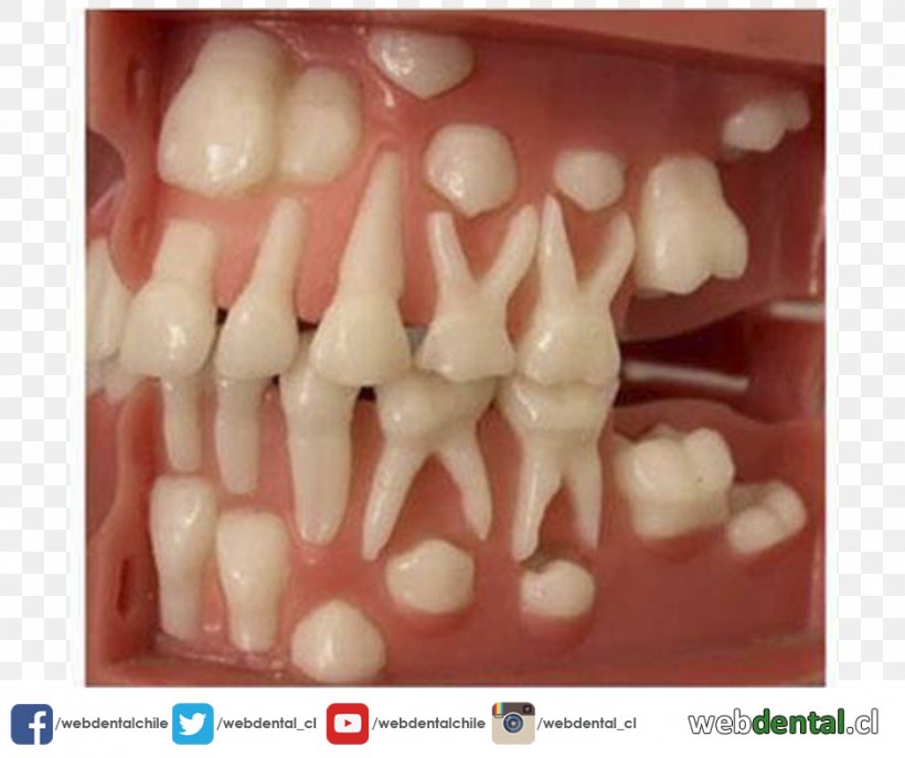 Tooth Eruption Deciduous Teeth Permanent Teeth Human Tooth, PNG, 940x788px, Tooth, Child, Cosmetic Dentistry, Deciduous Teeth, Dentistry Download Free