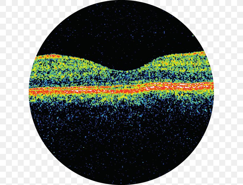 Astha Hospital Optical Coherence Tomography Critical Appraisal Medicine, PNG, 625x625px, Optical Coherence Tomography, Anand, Coherence, Critical Appraisal, Eye Download Free