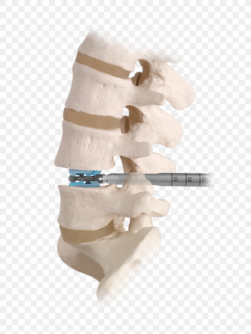 Spinal Fusion Vertebral Column Spinal Decompression Human Back Lumbar, PNG, 1500x1993px, Spinal Fusion, Back Pain, Bone, Decompression, Discectomy Download Free