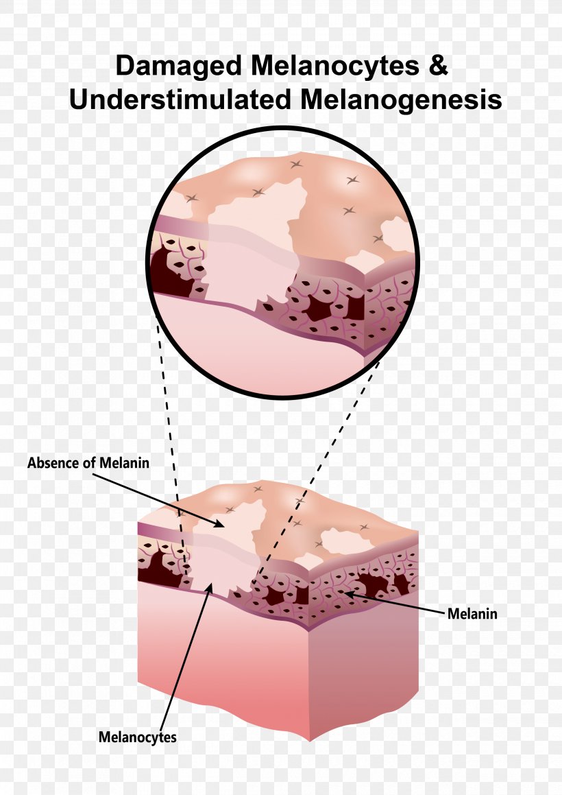 Melanocyte Melanin Scar Hypopigmentation Skin, PNG, 2480x3508px, Melanocyte, Brachioplasty, Cell, Depigmentation, Ear Download Free
