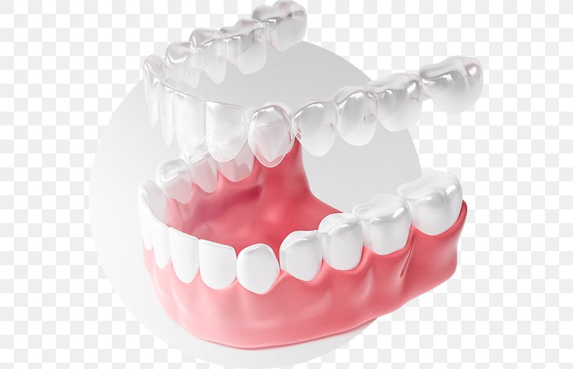 Tooth Элайнер Dental Braces Clear Aligners Zwarcie, PNG, 565x529px, Tooth, Clear Aligners, Crowding Of Teeth, Dental Braces, Dental Implant Download Free
