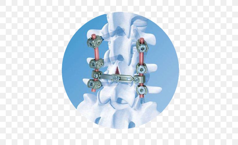 Vertebral Column DePuy Synthes Companies Osteosynthesis Spinal Cord Vertical Expandable Prosthetic Titanium Rib, PNG, 500x500px, Vertebral Column, Arthrodesis, Depuy Synthes Companies, Joint, Orthopaedics Download Free
