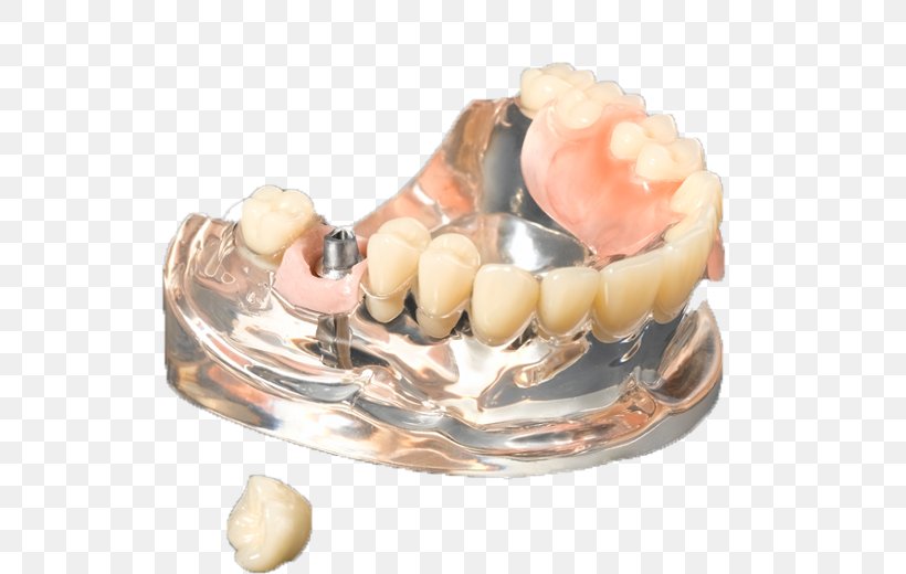 Medic Company Limited Crown Business Tooth Dental Implant, PNG, 600x520px, Crown, Business, Clam, Clams Oysters Mussels And Scallops, Dental Implant Download Free