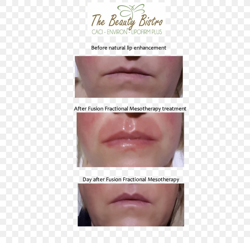 Mesotherapy Lip Gloss Eyelash Extensions Face, PNG, 533x800px, Mesotherapy, Cheek, Chin, Close Up, Cosmetics Download Free