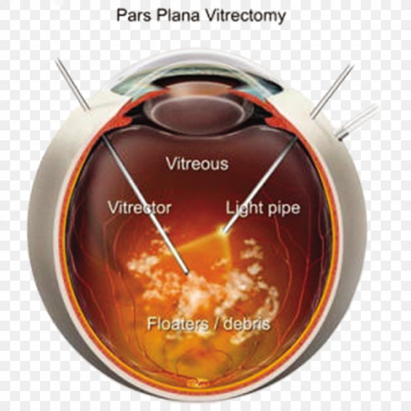 Diabetic Retinopathy Retina Vitreous Body Human Eye Laser, PNG, 1024x1024px, Diabetic Retinopathy, Alarm Clock, Eye, Eye Surgery, Human Eye Download Free