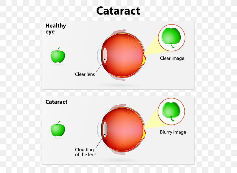 Cataract Surgery Intraocular Lens Human Eye, PNG, 600x600px, Cataract, Area, Brand, Cataract Surgery, Diagram Download Free