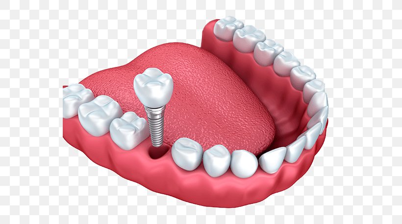 Dental Implant Dentistry Tooth, PNG, 564x458px, Dental Implant, Crown, Dental Extraction, Dentist, Dentistry Download Free