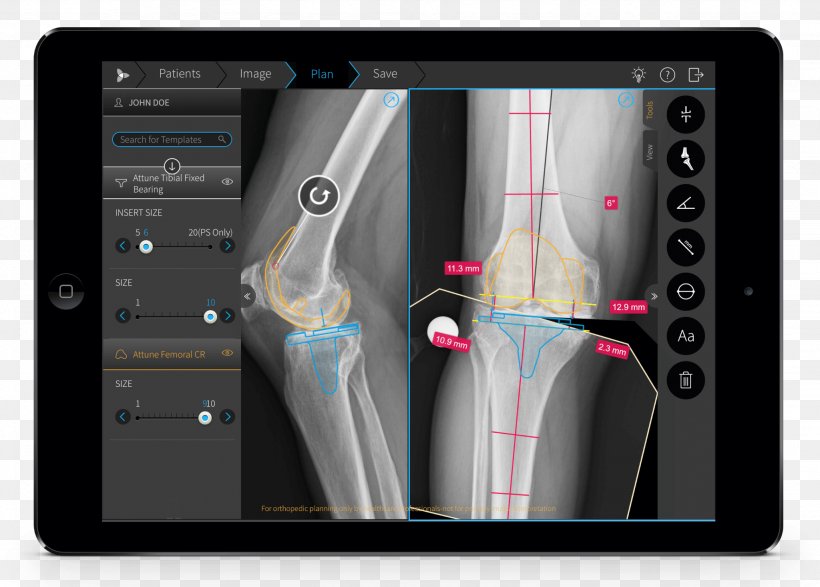 Brainlab Orthopedic Surgery Knee Replacement American Academy Of Orthopaedic Surgeons, PNG, 2048x1467px, Brainlab, Arthroplasty, Electronics, Gadget, Joint Download Free