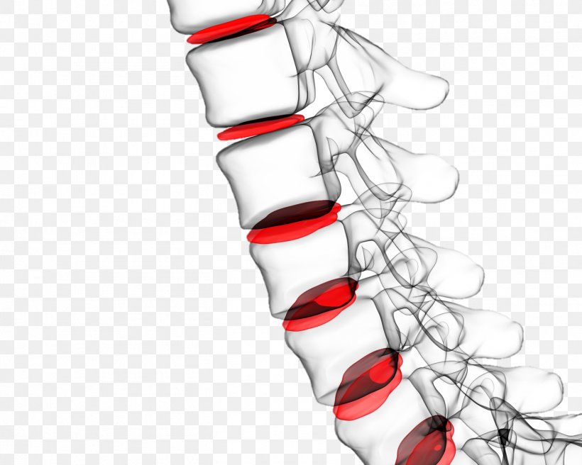 Vertebral Column Low Back Pain Spinal Disc Herniation Human Back, PNG, 1406x1125px, Vertebral Column, Arm, Back Pain, Bone, Footwear Download Free
