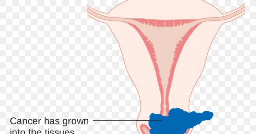 Cervical Cancer Staging Cervix, PNG, 1200x630px, Watercolor, Cartoon, Flower, Frame, Heart Download Free