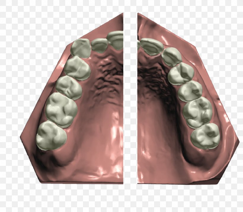 Orthodontics CAD/CAM Dentistry Dental Implant Dental Braces, PNG, 1289x1126px, Orthodontics, Abutment, Cadcam Dentistry, Chocolate, Clear Aligners Download Free