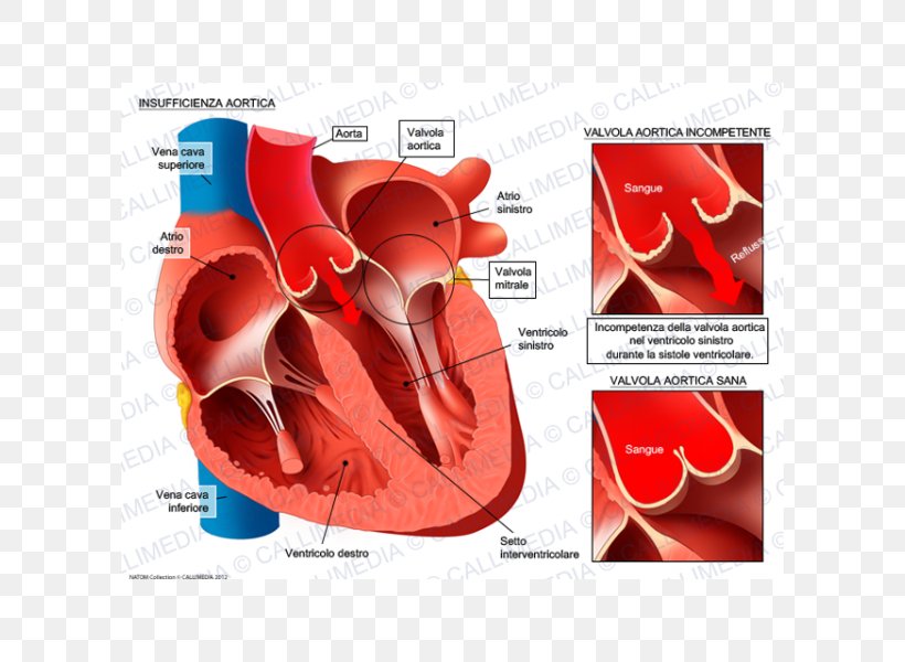 Valvular Aortic Stenosis Aortic Insufficiency Aortic Valve Mitral Insufficiency Mitral Valve, PNG, 600x600px, Watercolor, Cartoon, Flower, Frame, Heart Download Free