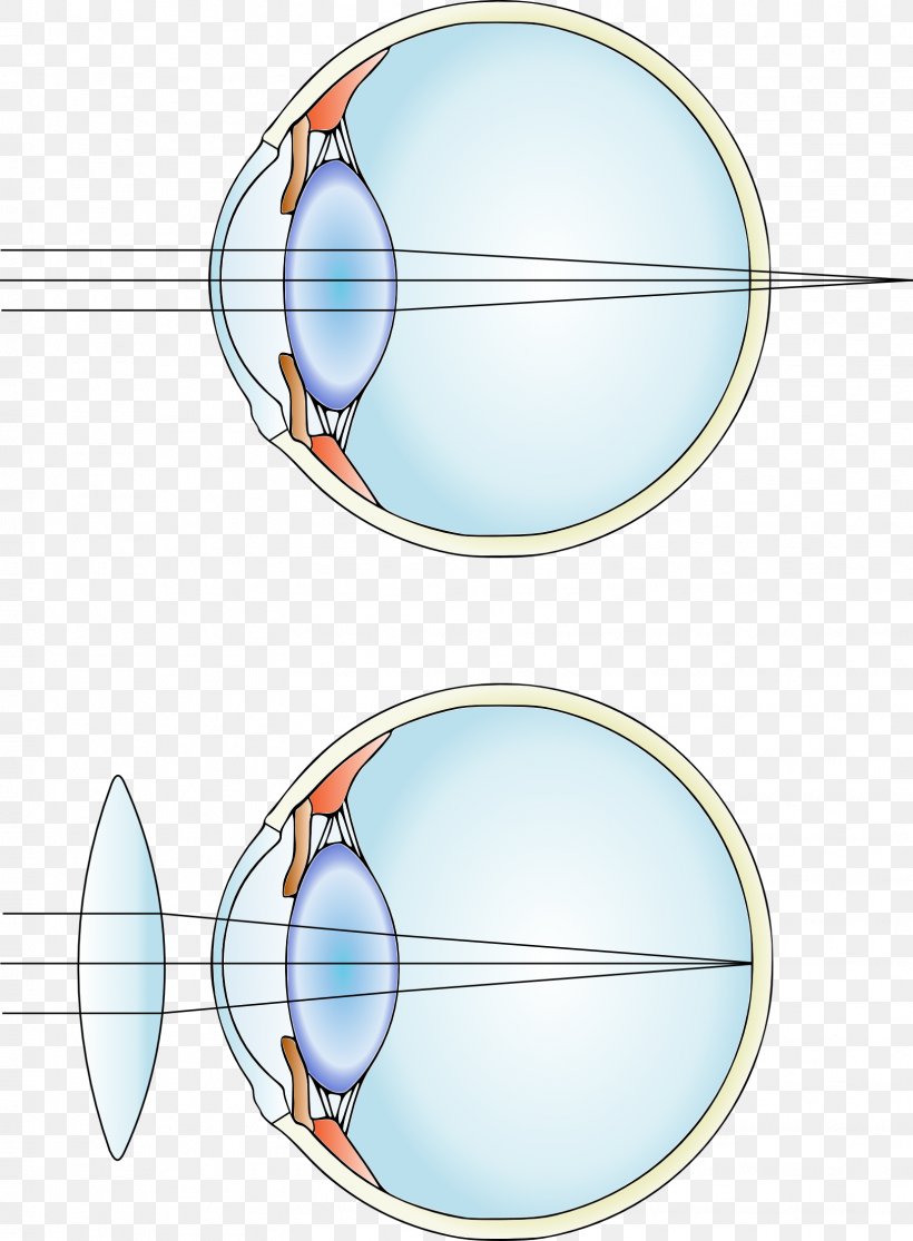 Near-sightedness Corrective Lens Hypermetropia Contact Lenses, PNG, 1624x2209px, Nearsightedness, Area, Astigmatism, Cataract, Contact Lenses Download Free