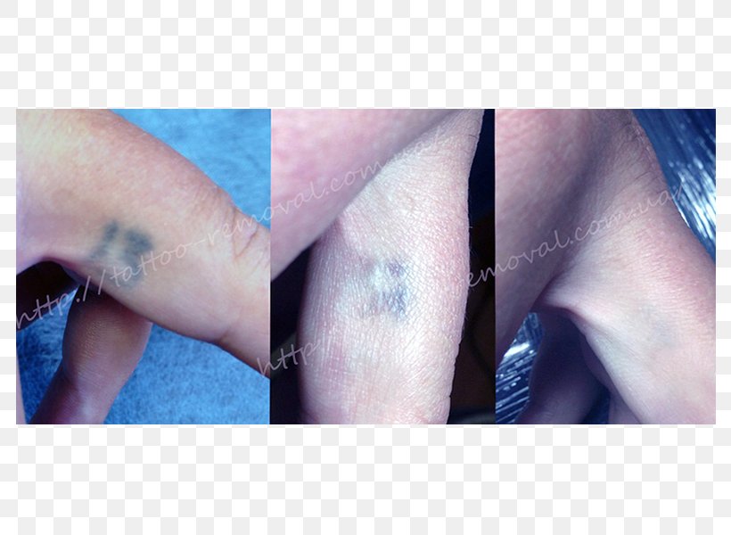 Tattoo Removal Permanent Makeup Scar Q-switching, PNG, 800x600px, Tattoo, Arm, Blue, Chin, Close Up Download Free