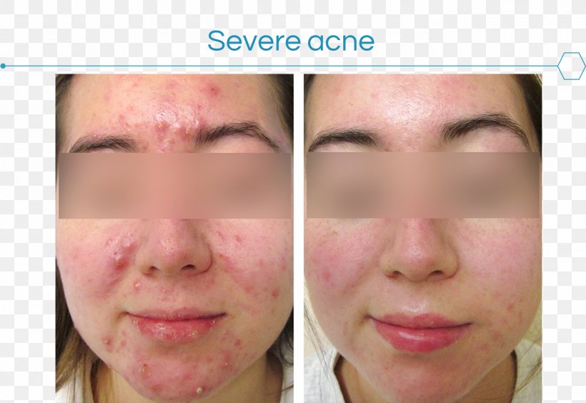 Acne Skin Face Dermatology Therapy, PNG, 1385x954px, Acne, Acne Cosmetica, Acne Fulminans, Cheek, Chin Download Free