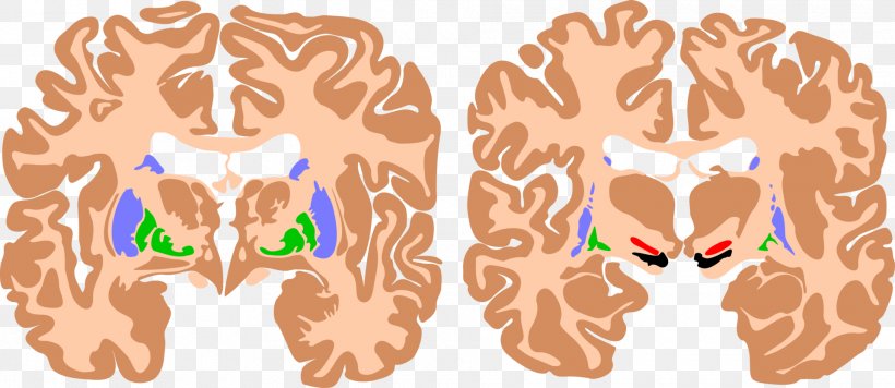 Basal Ganglia Brain Athetoid Cerebral Palsy Cerebral Cortex, PNG, 1920x834px, Watercolor, Cartoon, Flower, Frame, Heart Download Free