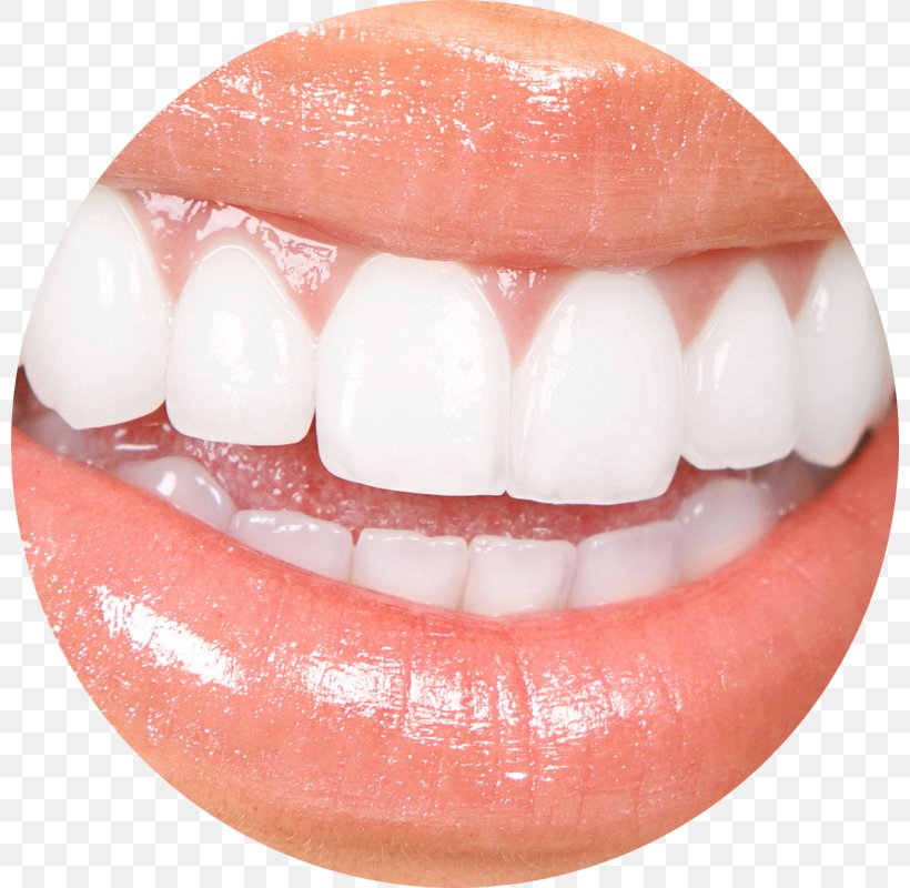 Veneer Cosmetic Dentistry Tooth Whitening, PNG, 800x800px, Veneer, Cosmetic Dentistry, Crown, Dental Composite, Dental Implant Download Free