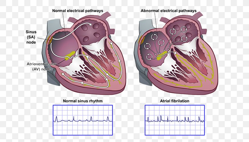 Heart Arrhythmia AV Nodal Reentrant Tachycardia Atrial Fibrillation Sinoatrial Node Atrium, PNG, 650x469px, Watercolor, Cartoon, Flower, Frame, Heart Download Free