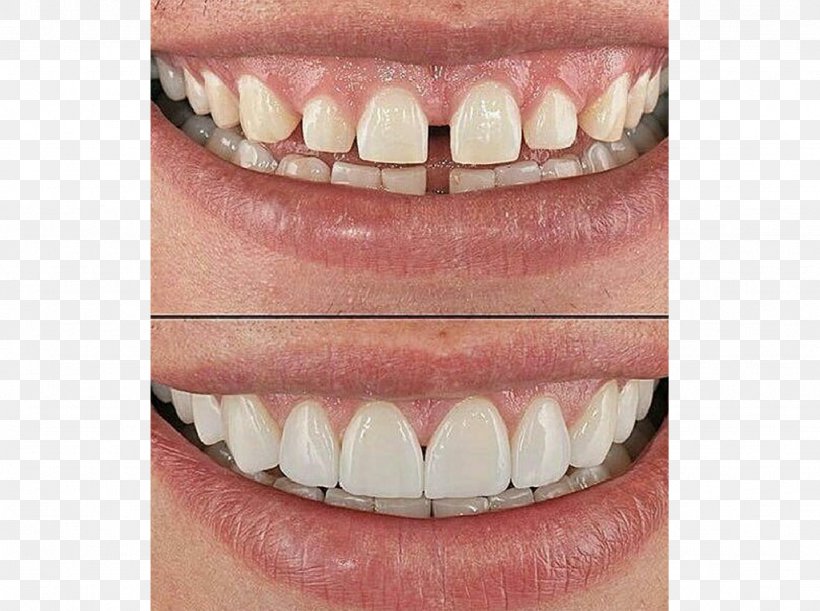 Tooth Veneer Dentistry Farza Optical, PNG, 1024x764px, Tooth, Cosmetic Dentistry, Crown, Dental Implant, Dental Surgery Download Free