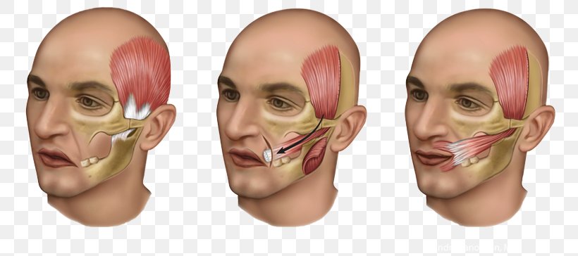 Temporal Muscle Surgery Tendon Buccal Fat Pad, PNG, 800x364px, Temporal Muscle, Anatomy, Buccal Fat Pad, Cheek, Face Download Free
