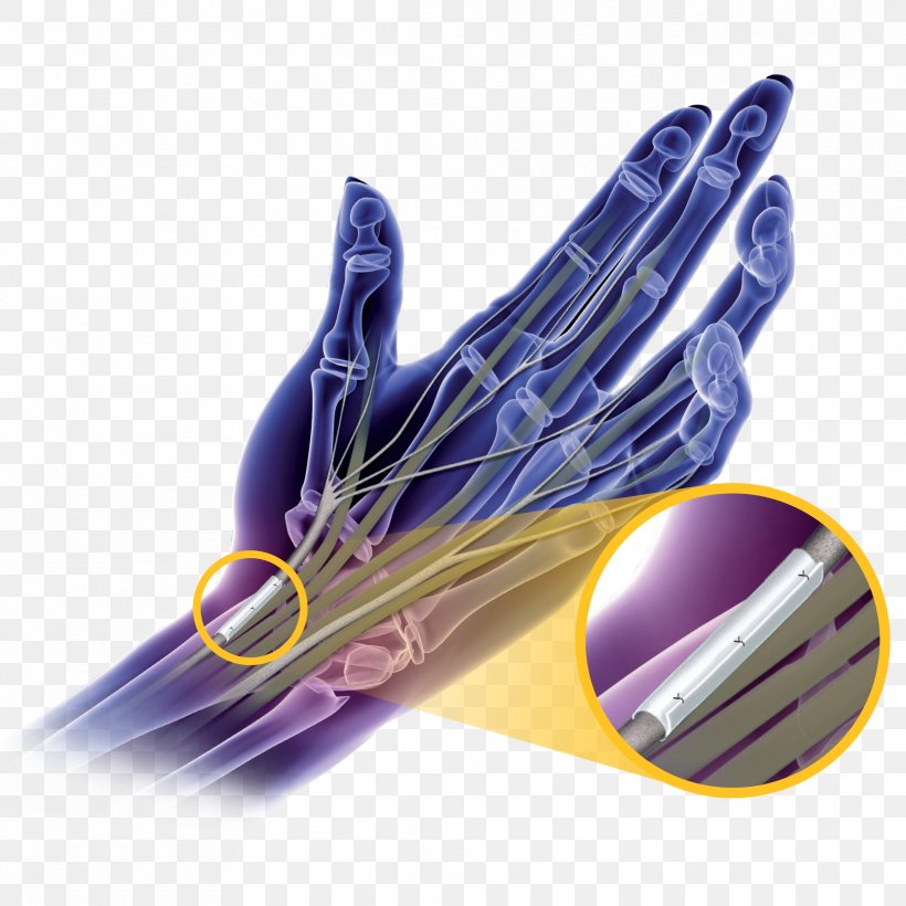 Carpal Tunnel Syndrome Surgery Nerve Hand, PNG, 1974x1974px, Carpal Tunnel Syndrome, Adhesion, Carpal Bones, Carpal Tunnel, Disease Download Free