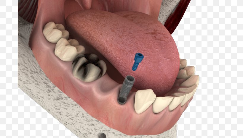 Dental Implant Dentistry Therapy Tooth, PNG, 700x467px, Dental Implant, Bone, Dentist, Dentistry, Dentures Download Free