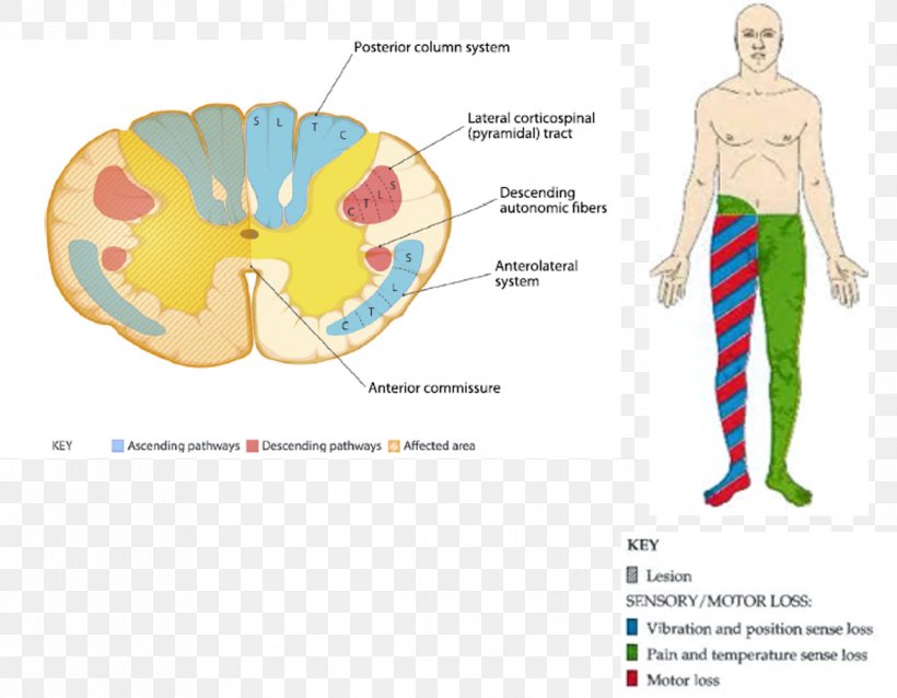 Central Cord Syndrome Brain Spinal Cord Injury Upper Motor Neuron Syndrome, PNG, 1170x911px, Watercolor, Cartoon, Flower, Frame, Heart Download Free