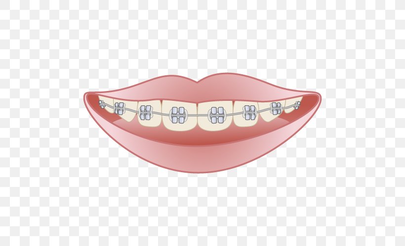 矯正歯科 Dentist Dental Braces Mouthguard Damon System, PNG, 500x500px, Dentist, Clinic, Damon System, Dental Braces, Dentistry Download Free