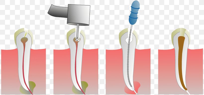 Endodontic Therapy Root Canal Dentist Endodontics Pulp, PNG, 816x384px, Endodontic Therapy, Brush, Cosmetic Dentistry, Dental Extraction, Dental Restoration Download Free