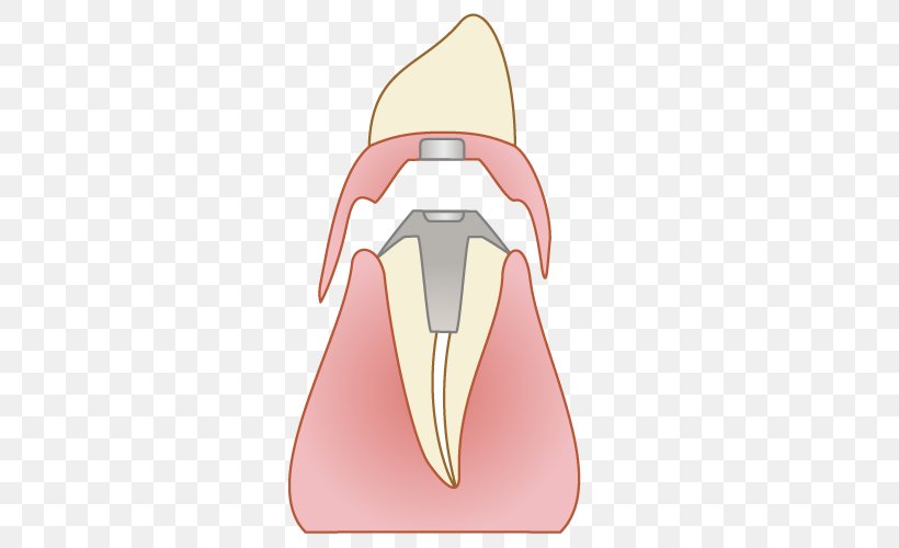 ふれあいファミリー歯科 Dentist Tooth Bridge Dental Implant, PNG, 500x500px, Dentist, Bridge, Dental Implant, Dentures, Implant Download Free