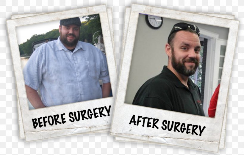 Tom Segura Weight Loss Gastric Bypass Surgery Sleeve Gastrectomy Roux-en-Y Anastomosis, PNG, 1030x658px, Weight Loss, Bariatric Surgery, Brand, Calorie, Gastrectomy Download Free