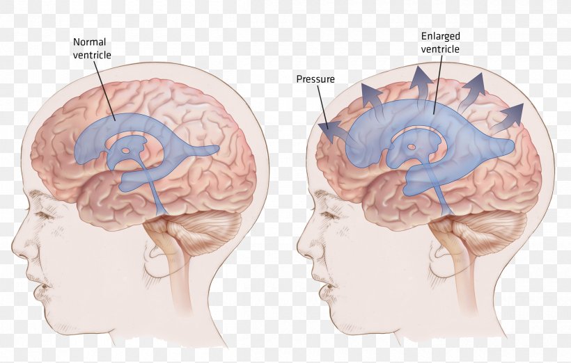 Ventricular System Normal Pressure Hydrocephalus Shunt Brain, PNG, 2400x1528px, Watercolor, Cartoon, Flower, Frame, Heart Download Free