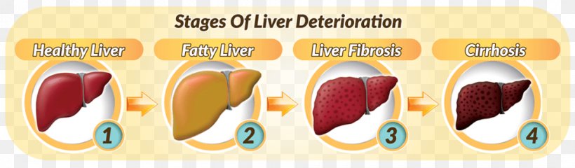 Fatty Liver Dietary Supplement Hepatocyte Liver Disease, PNG, 1000x293px, Liver, Cell, Detoxification, Dietary Supplement, Fat Download Free