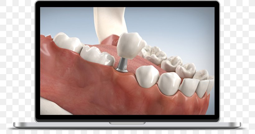 Dental Implant Dentistry Tooth Dentures, PNG, 798x434px, Dental Implant, Bridge, Dental Laboratory, Dentist, Dentistry Download Free