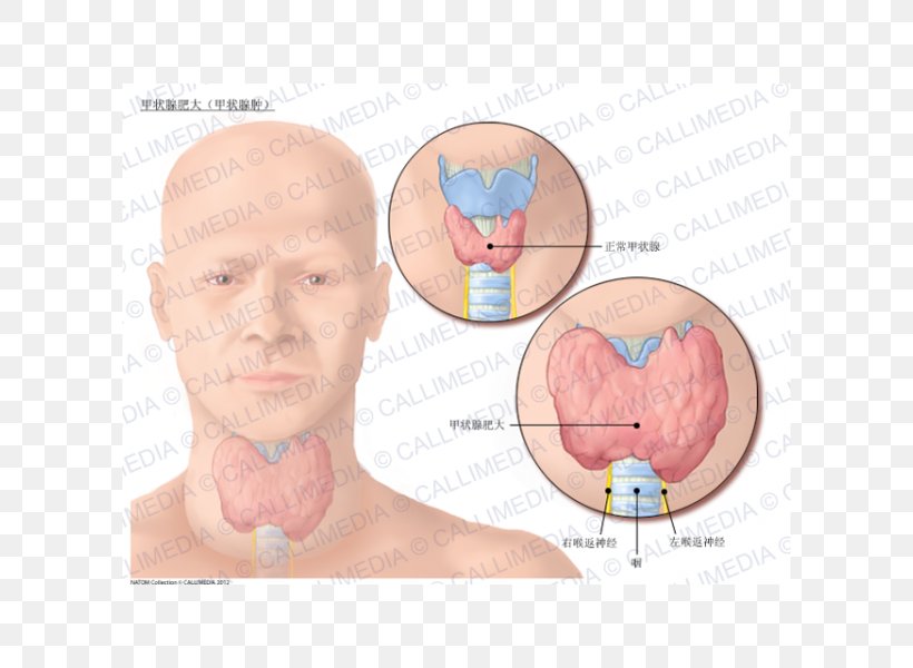 Nodule Goitre Graves' Disease Hyperthyroidism, PNG, 600x600px, Watercolor, Cartoon, Flower, Frame, Heart Download Free