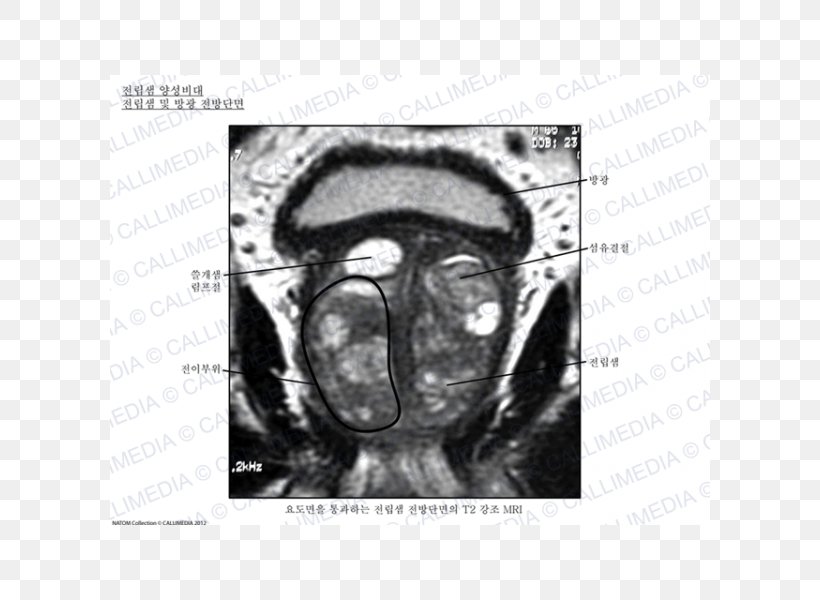 Prostate Urinary Bladder Urology Benign Prostatic Hyperplasia Anatomy, PNG, 600x600px, Watercolor, Cartoon, Flower, Frame, Heart Download Free