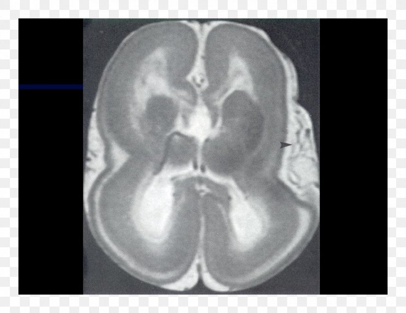 Computed Tomography Brain Radiology Magnetic Resonance Imaging Lääketieteellinen Röntgenkuvaus, PNG, 1584x1224px, Watercolor, Cartoon, Flower, Frame, Heart Download Free