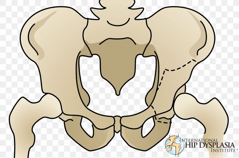 Osteotomy Hip Dysplasia Acetabulum Pelvis, PNG, 1313x869px, Watercolor, Cartoon, Flower, Frame, Heart Download Free