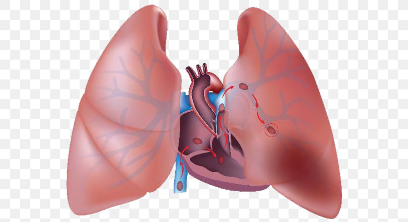 Pulmonary Embolism Thrombus Pulmonary Artery Embolus Lung, PNG, 600x447px, Watercolor, Cartoon, Flower, Frame, Heart Download Free