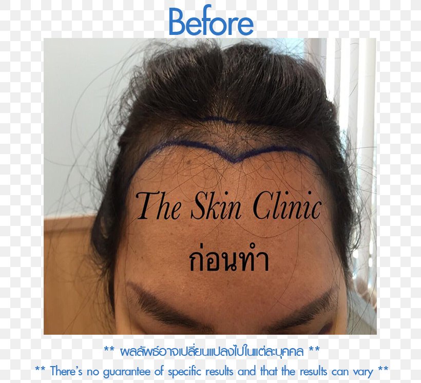 Follicular Unit Extraction Eyebrow Forehead Cheek Nose, PNG, 730x746px, Follicular Unit Extraction, Botak, Cheek, Chin, Ear Download Free