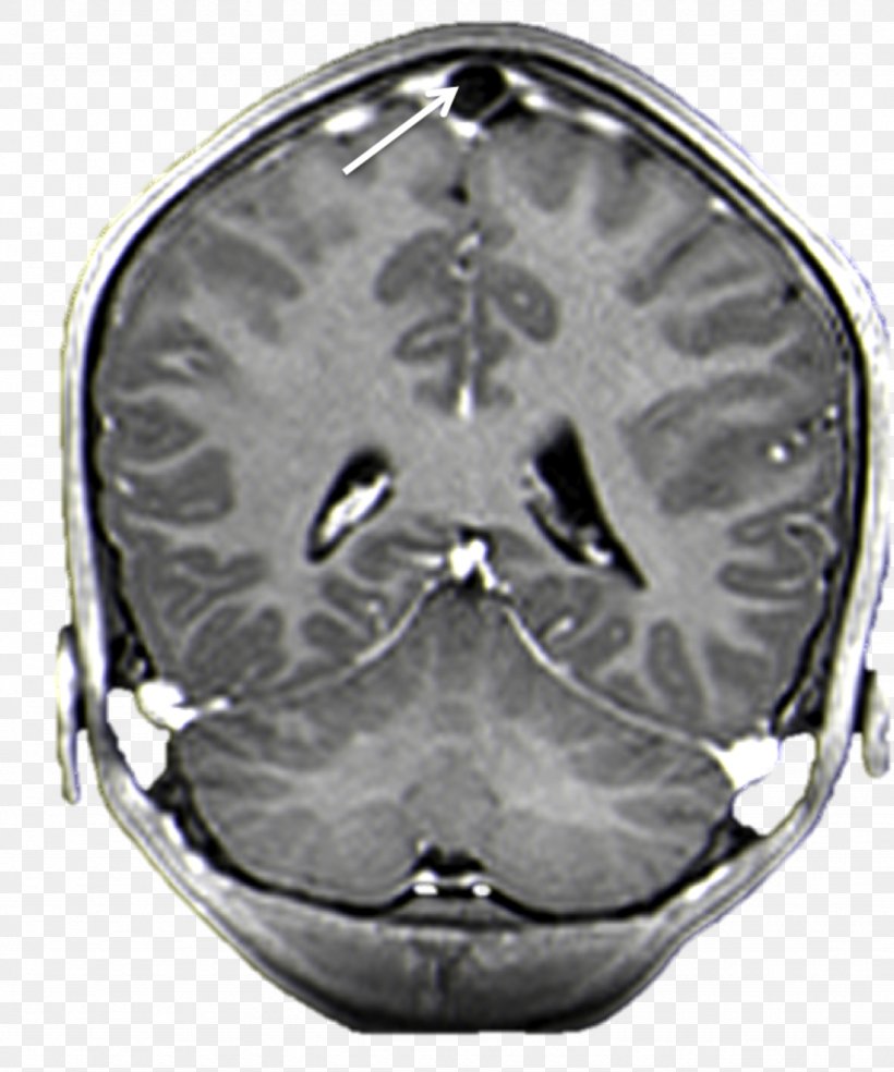 Brain Arachnoid Granulation Superior Sagittal Sinus Magnetic Resonance Imaging Arachnoid Mater, PNG, 1332x1600px, Watercolor, Cartoon, Flower, Frame, Heart Download Free