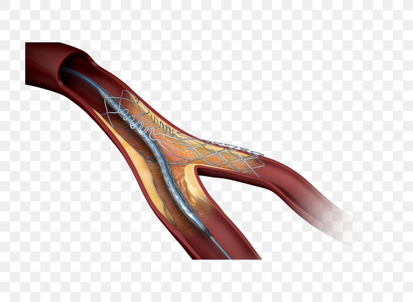 Stenting Drug-eluting Stent Coronary Artery Disease Heart Bare-metal Stent, PNG, 800x600px, Stenting, Artery, Baremetal Stent, Blood, Blood Vessel Download Free
