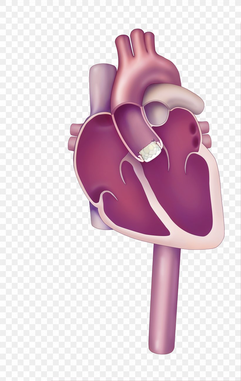 Percutaneous Aortic Valve Replacement Valvular Aortic Stenosis Heart Valve, PNG, 3300x5205px, Watercolor, Cartoon, Flower, Frame, Heart Download Free