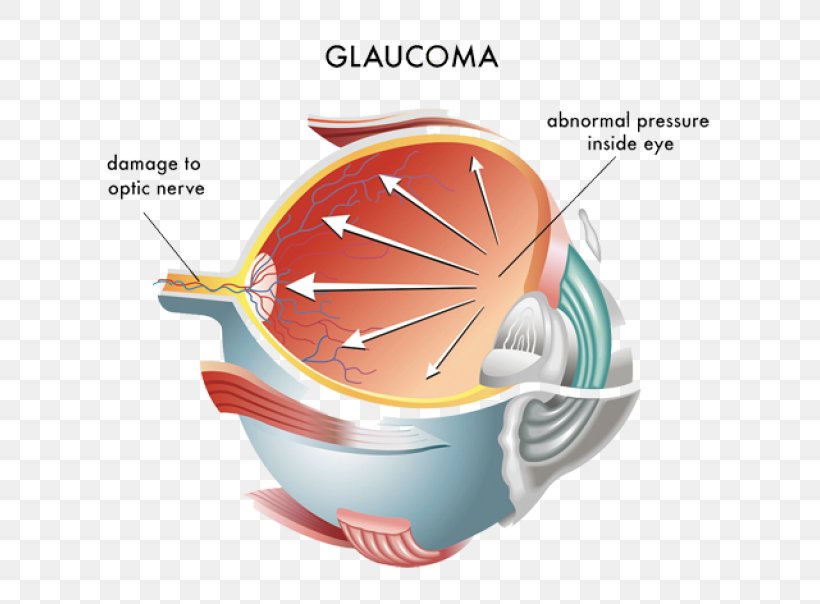 Intraocular Pressure Glaucoma Ocular Hypertension Eye Optic Nerve, PNG, 768x604px, Intraocular Pressure, Cup, Disease, Eye, Eye Care Professional Download Free
