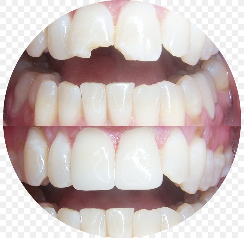 Tooth Dentistry Veneer Crown, PNG, 800x800px, Tooth, Cosmetic Dentistry, Crown, Dental Implant, Dentist Download Free
