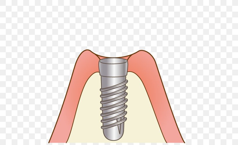 審美歯科 Dentist 矯正歯科 けやき歯科クリニック, PNG, 500x500px, Dentist, Dental Implant, Dentures, Hardware, Joint Download Free