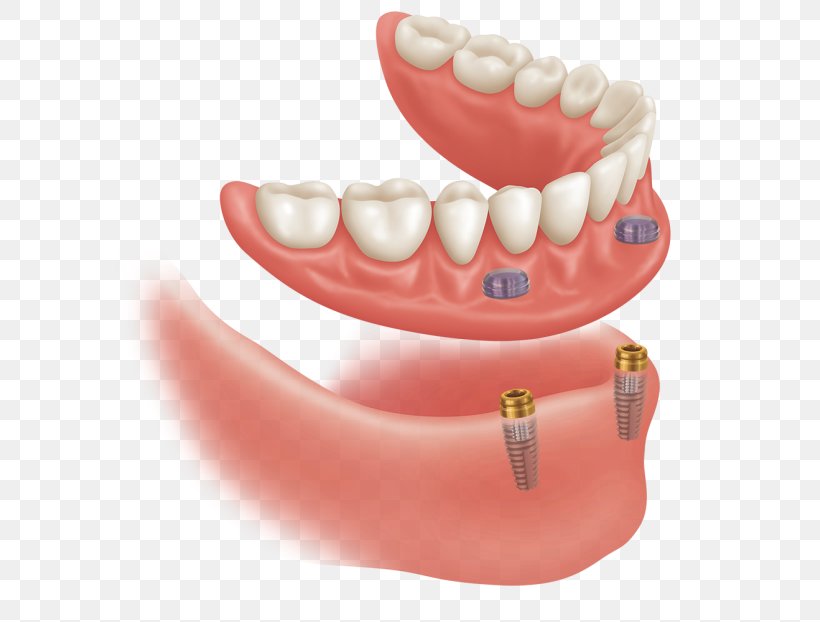 Dental Implant Dentures Dentistry Abutment, PNG, 622x622px, Dental Implant, Abutment, Chin, Cosmetic Dentistry, Dental Laboratory Download Free