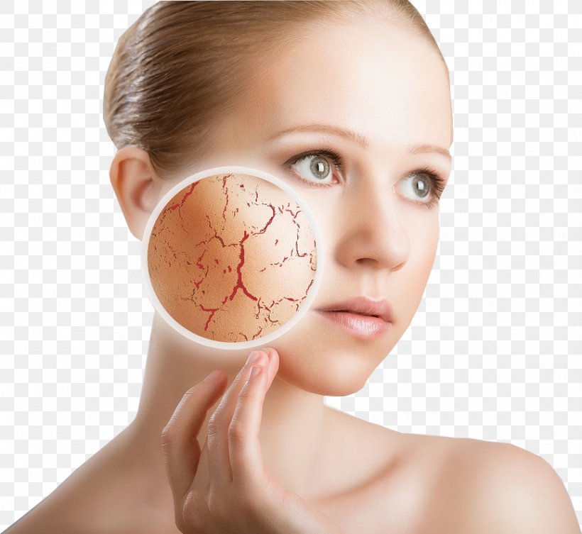 Lotion Sensitive Skin Xeroderma Skin Care, PNG, 865x795px  